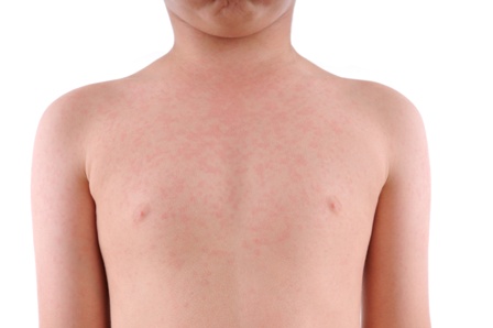 Measles Case in California or Drains Full in Your Town?