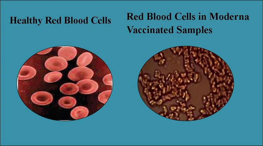 Vaccinated Blood Samples Show Abnormal Red Blood Cells