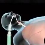 ventilator death illustration